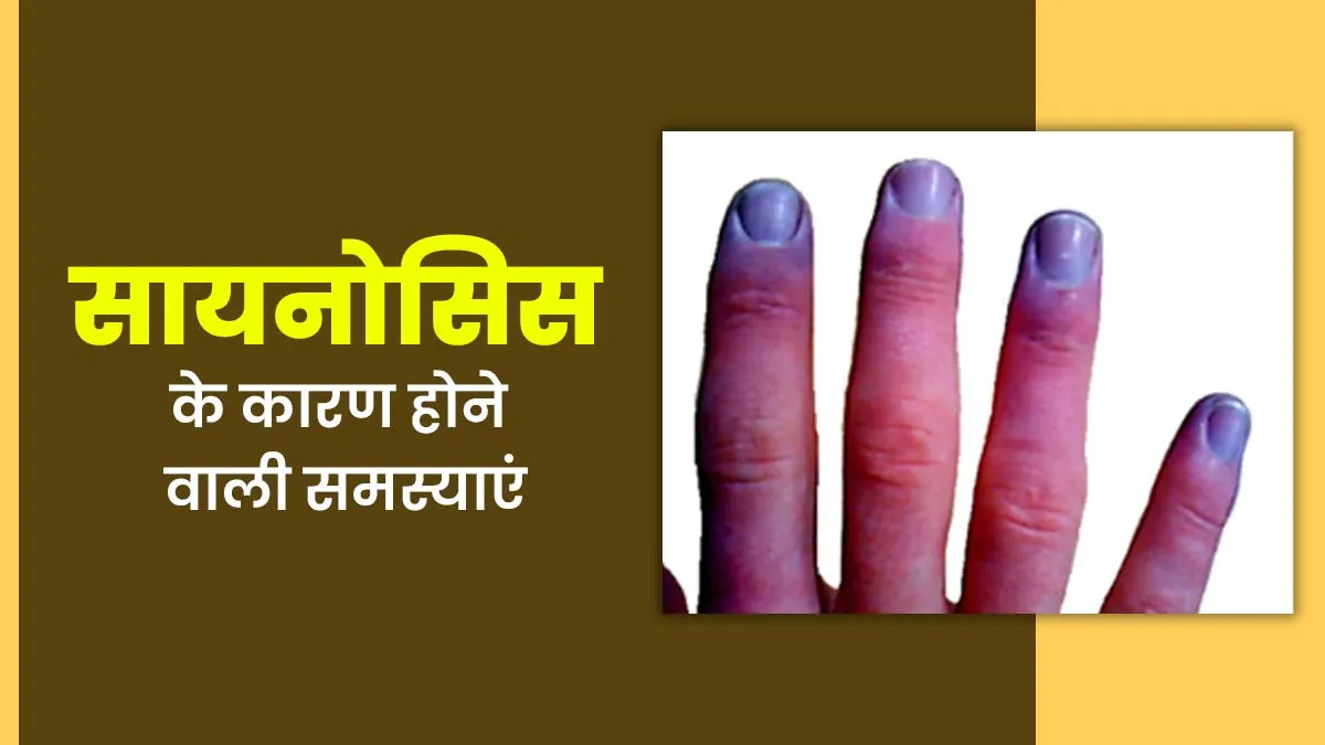 सायनोसिस (त्वचा का नीला या बैंगनी रंग होना) के कारण क्या गंभीर समस्याएं हो सकती हैं, डॉक्टर से जानें