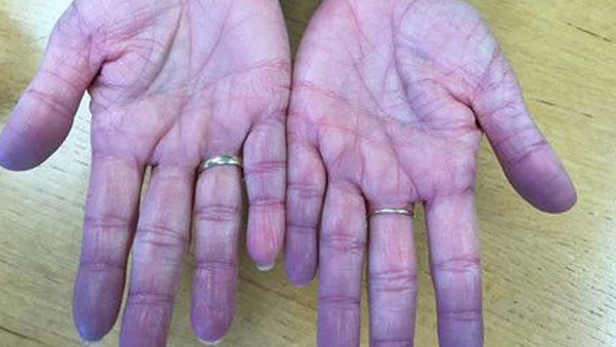 complications of cyanosis