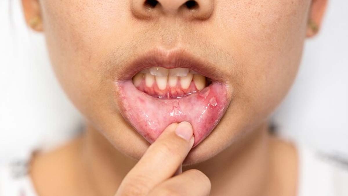 mouth_ulcers_causes_in_hindi