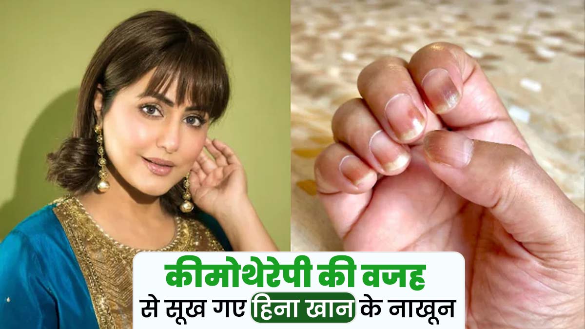 Hina Khan Chemotherapy: कीमोथेरेपी से सूख गए हिना खान के नाखून, डॉक्टर से जानें कीमोथेरेपी का असर नाखून पर दिखता है या नहीं
