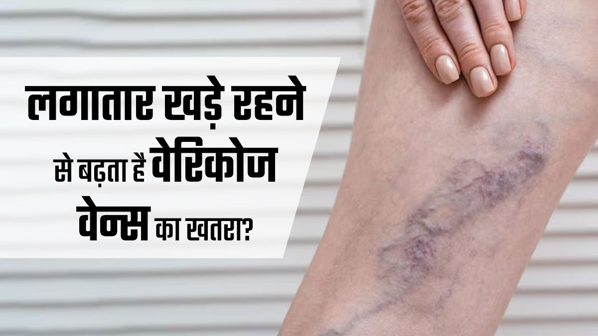 क्या लगातार खड़े रहने की आदत से बढ़ सकता है वेरिकोज वेन्स का खतरा? जानें डॉक्‍टर से