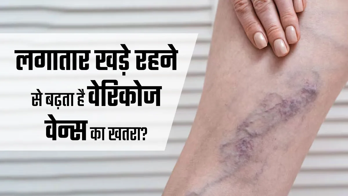 क्या लगातार खड़े रहने की आदत से बढ़ सकता है वेरिकोज वेन्स का खतरा? जानें डॉक्‍टर से