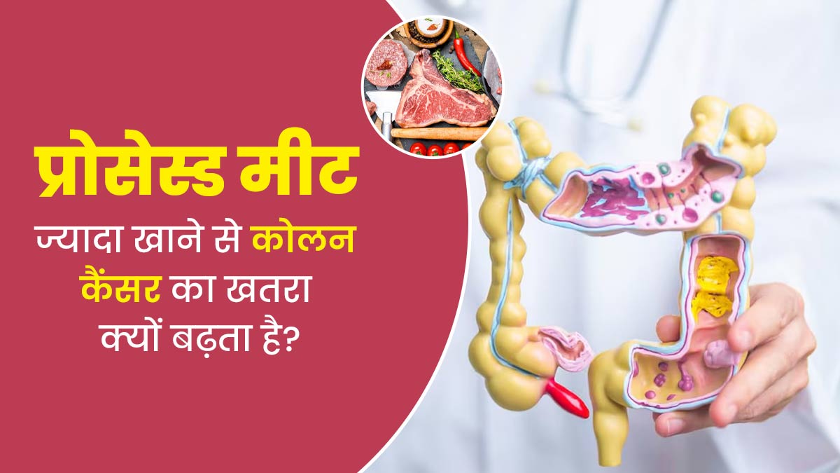 प्रोसेस्ड मीट ज्यादा खाने से कोलन कैंसर का खतरा क्यों बढ़ता है? डॉक्टर से जानें