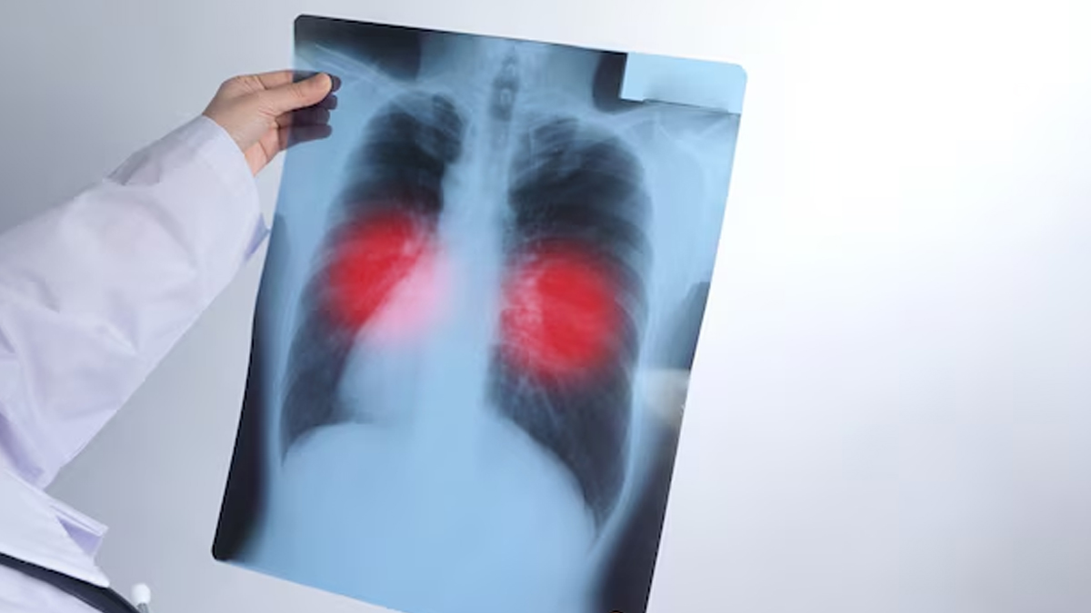 World-Tuberculosis-Day-2025-Theme-Significance-and-history-ins1