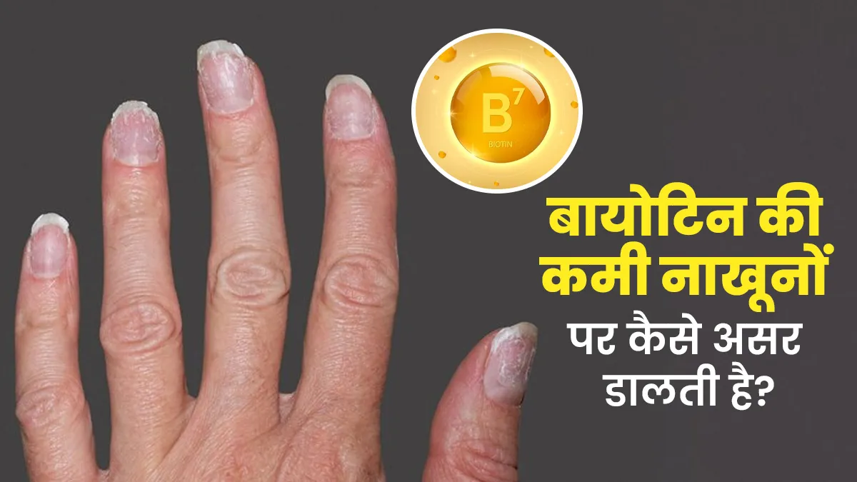 बायोटिन की कमी नाखूनों पर कैसे असर डालती है? जानें डॉक्टर से