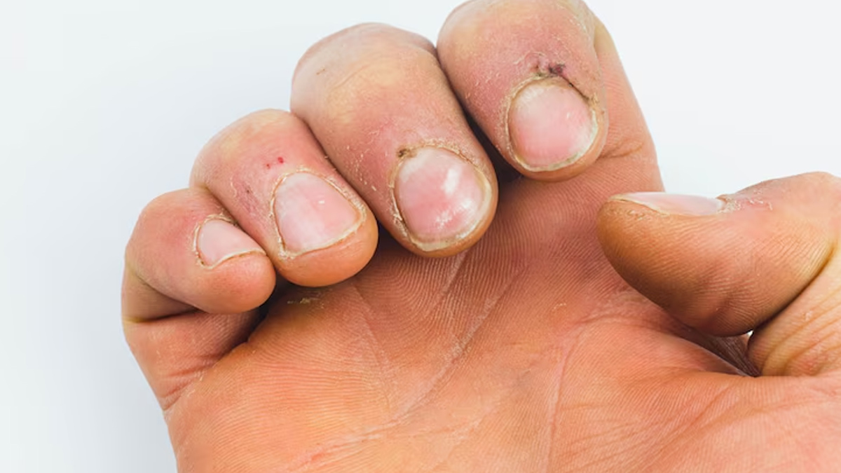 how does lack of biotin in the body affect nails 01