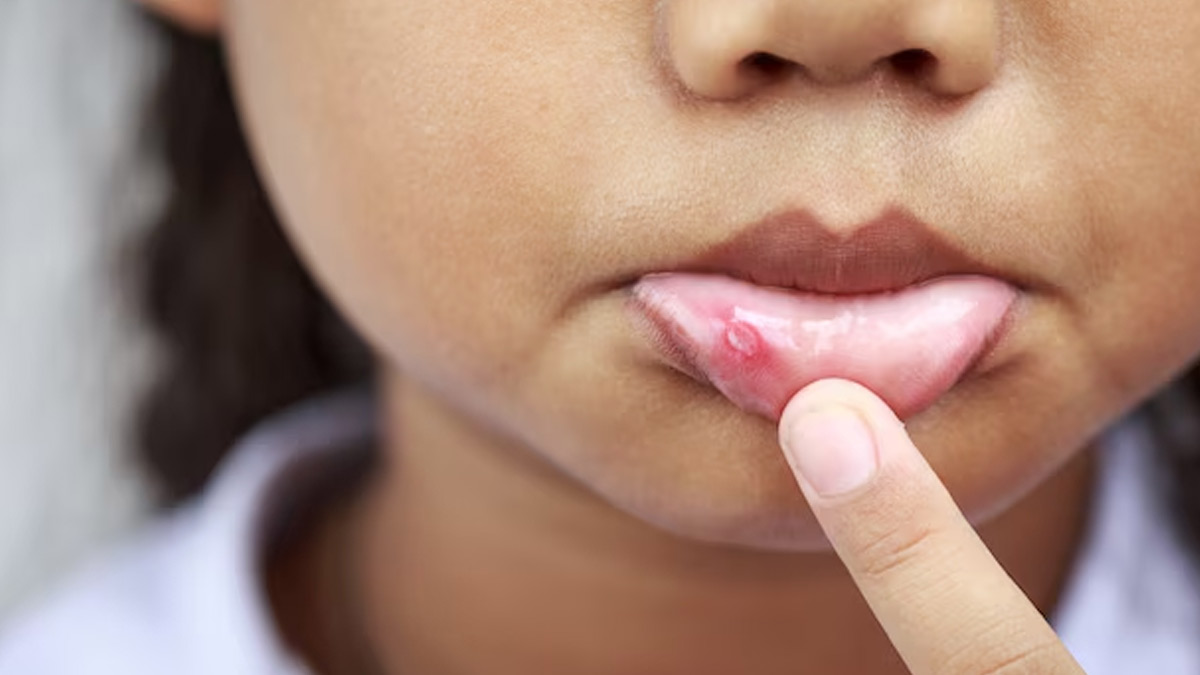 Which-people-are-more-at-risk-of-lip-cancer-inside2