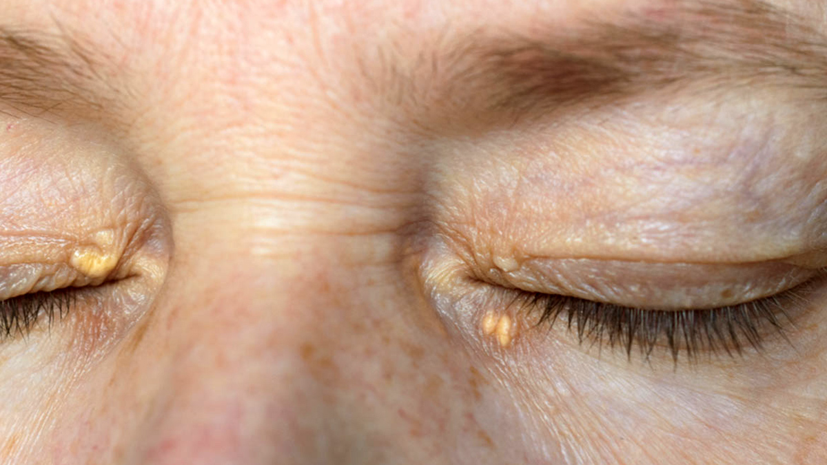 Xanthelasma treatment