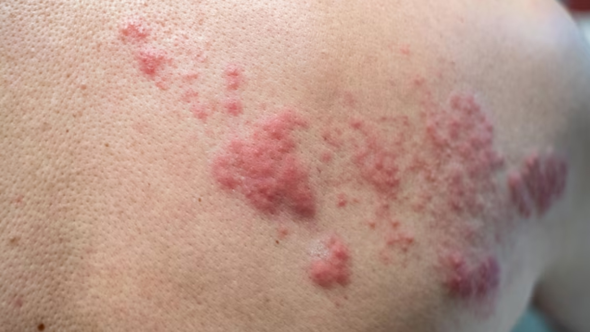 shingles home remedies