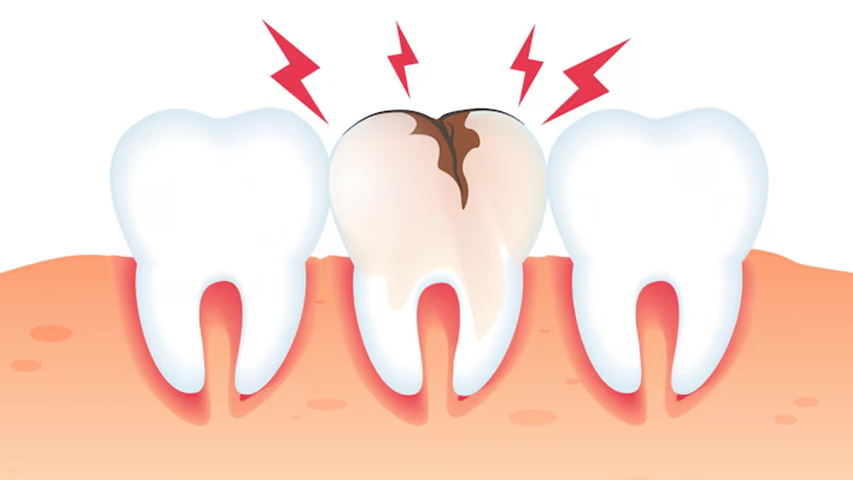 Exposed Tooth Roots