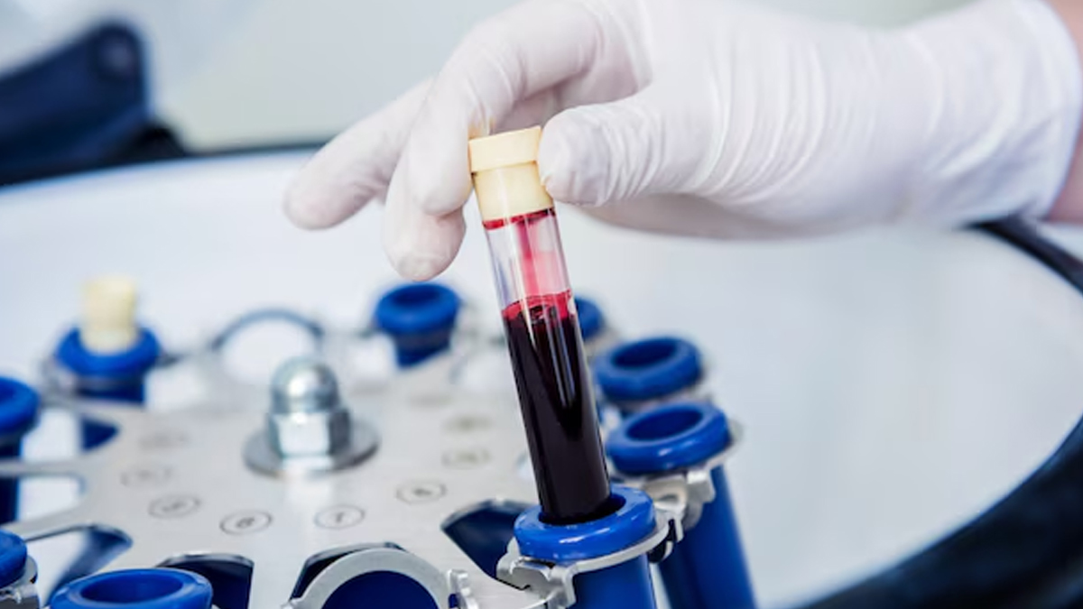 Plasmapheresis