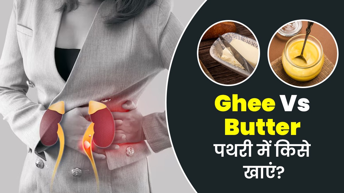 घी या बटर, पथरी में क्या खाना चाहिए? एक्सपर्ट से जानें किडनी पर इन दोनों का असर
