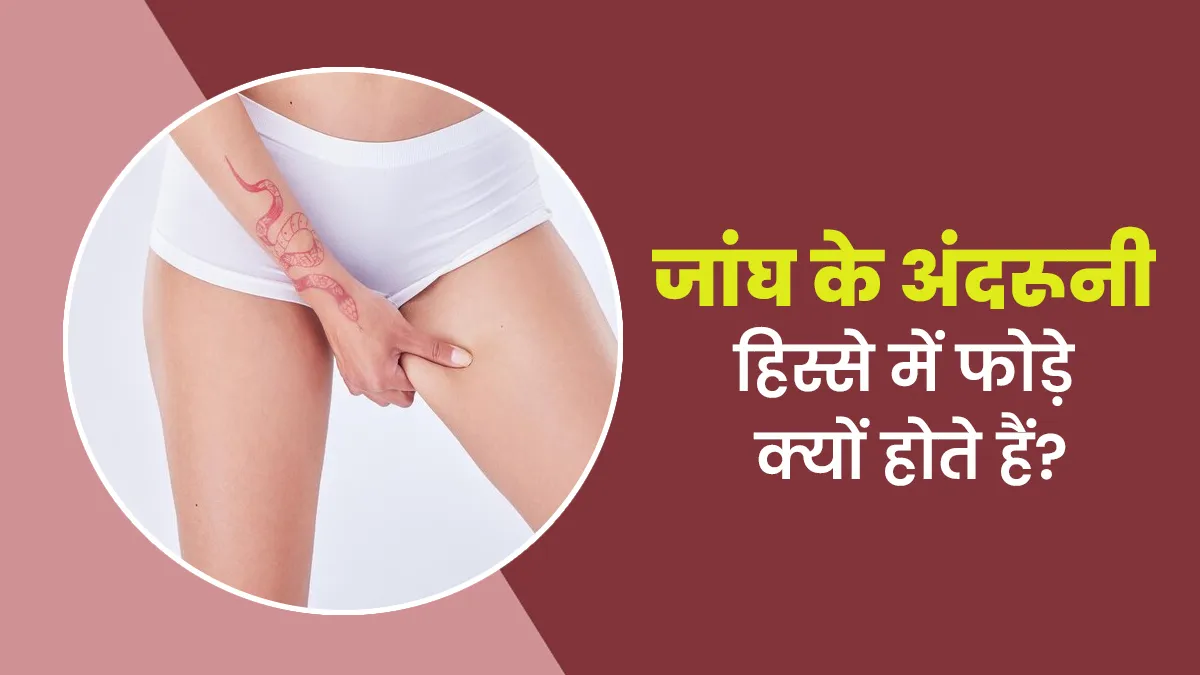 जांघ के अंदरूनी हिस्से पर फोड़ा क्यों होता है और इसका इलाज कैसे करें? जानें डॉक्टर से