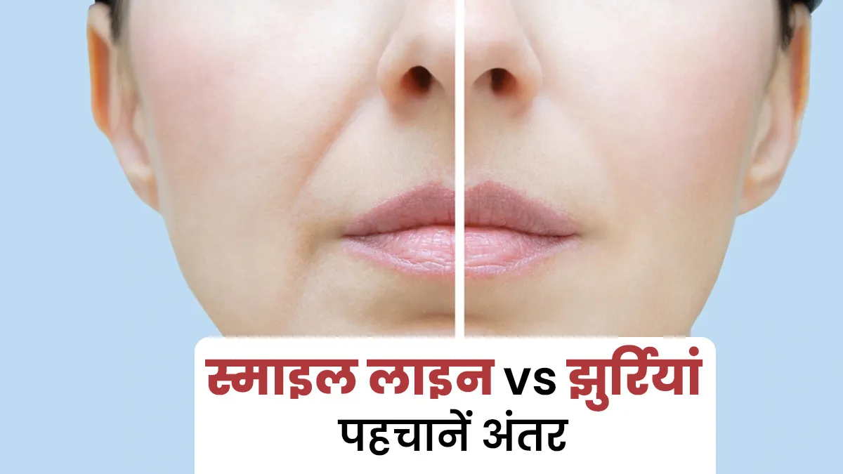 स्‍माइल लाइन vs झुर्र‍ियां: जानें इनके बीच का अंतर और डॉक्‍टर से जानें इलाज