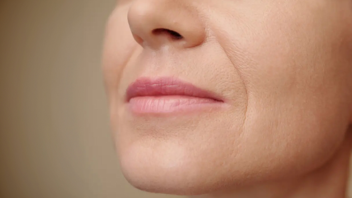 smile-lines-vs-wrinkles