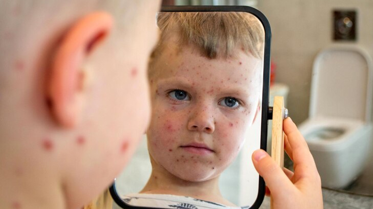 home-remedies-for-baby-acne-marks-i