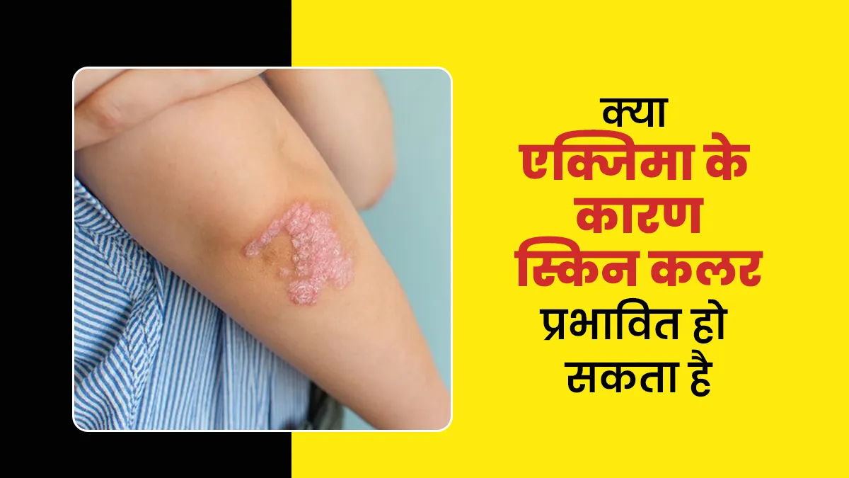 एक्जिमा के कारण स्किन कलर प्रभावित हो सकता है? समझें डर्मेटोलॉजिस्ट से