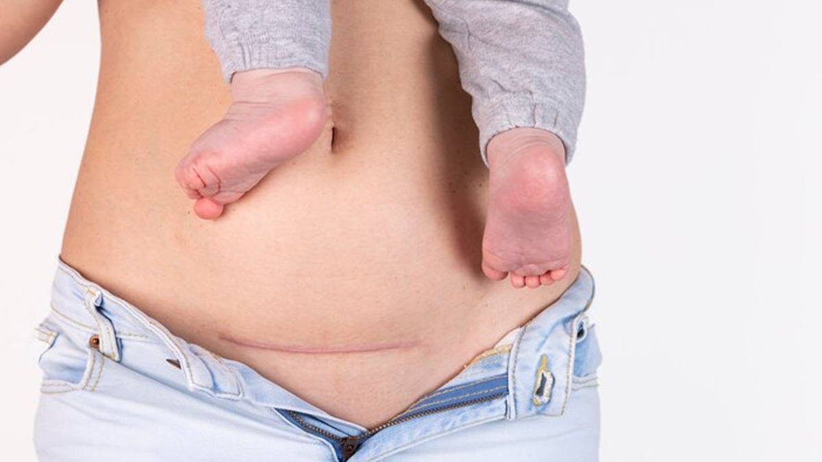C-section