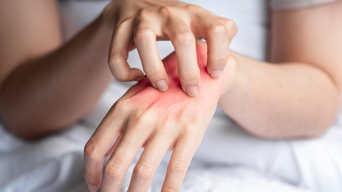 does eczema cause discoloration 1 (2)