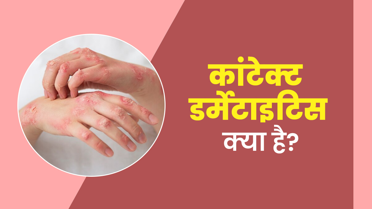 कॉन्टैक्ट डर्मेटाइटिस क्या है और इससे कैसे बचें? डॉक्टर से जानें