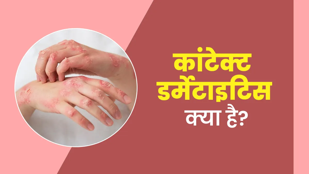 कॉन्टैक्ट डर्मेटाइटिस क्या है और इससे कैसे बचें? डॉक्टर से जानें