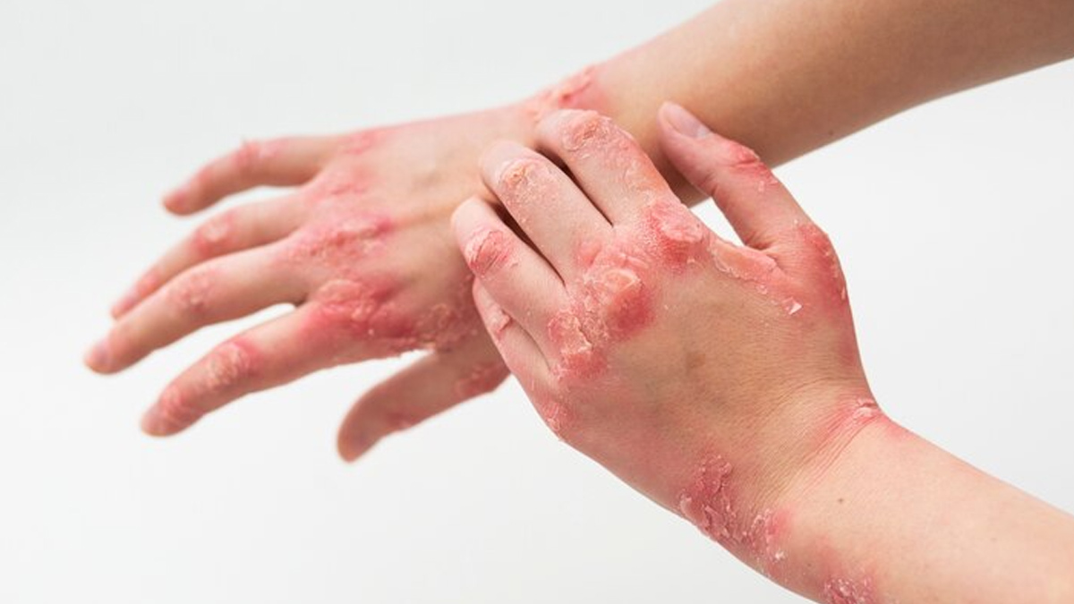 contact dermatities