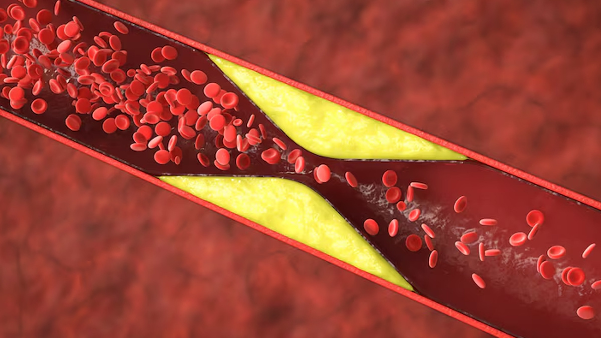 can high cholesterol cause acidity in hindi 01