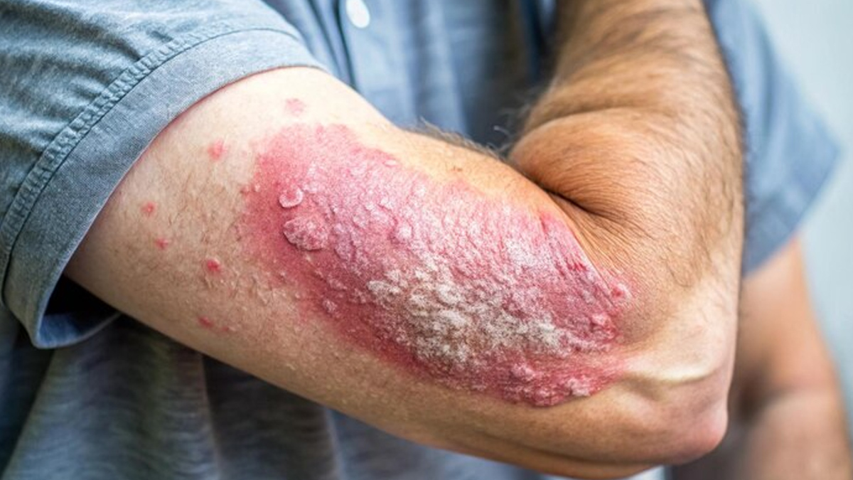 psoriosis-inside