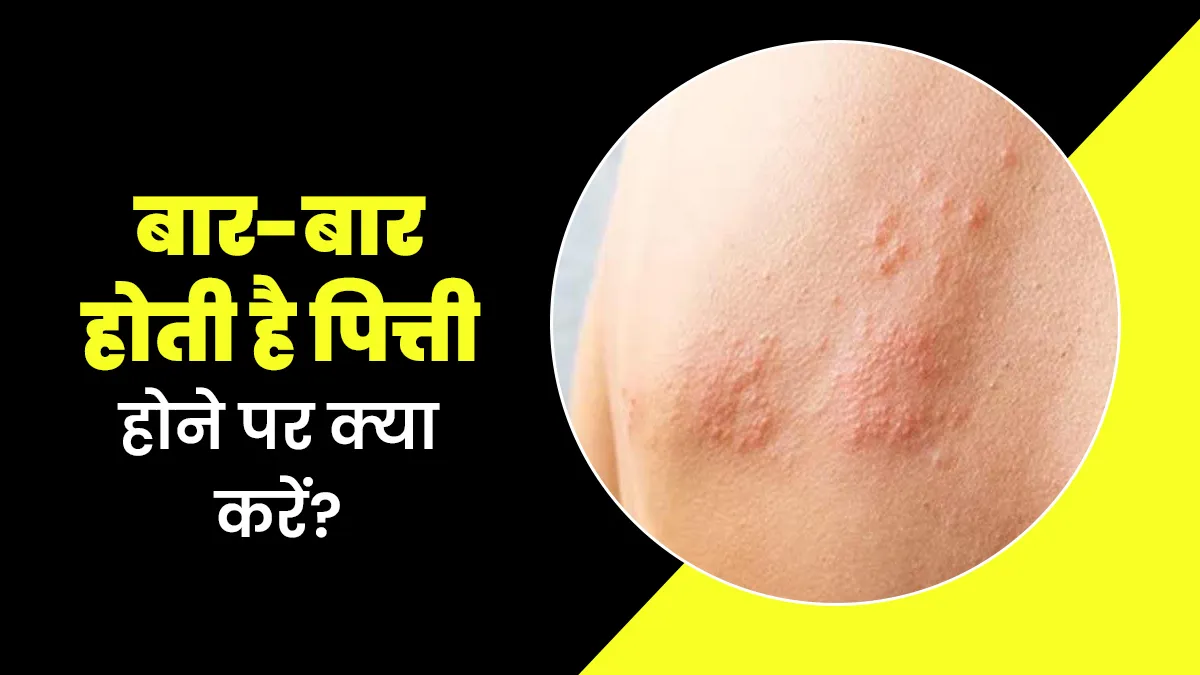बार-बार होती है पित्ती की समस्या? आयुर्वेदिक एक्सपर्ट से जानें कैसे करें कंट्रोल