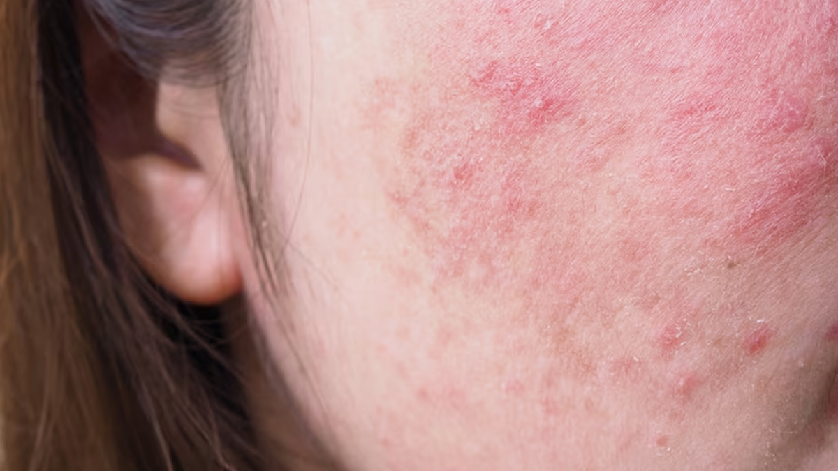 Seborrheic dermatitis