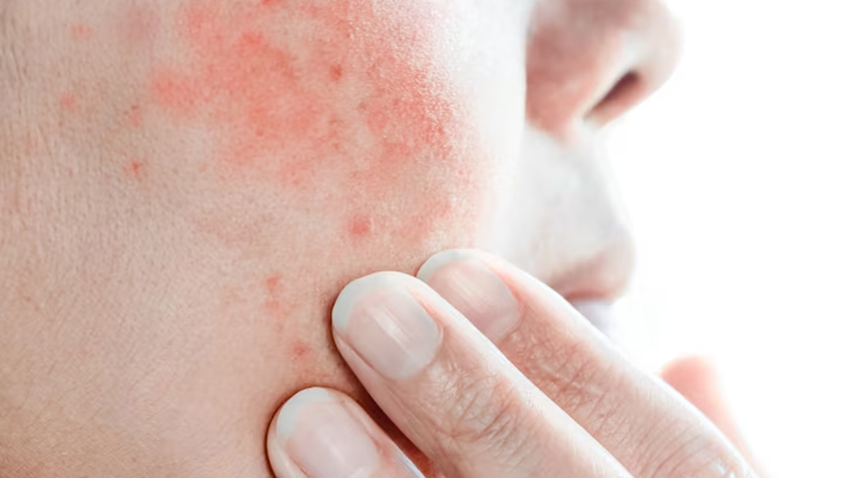 eating mango can cause skin allergy