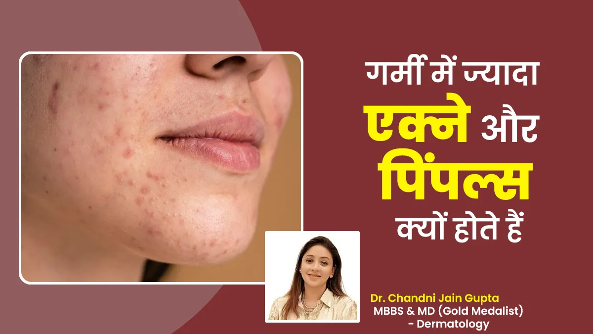 गर्मी में ज्यादा एक्ने और पिंपल्स क्यों होते हैं? बता रहे हैं डॉक्टर