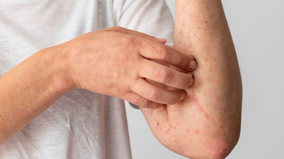 What Are the Risk Factors Of Psoriasis main