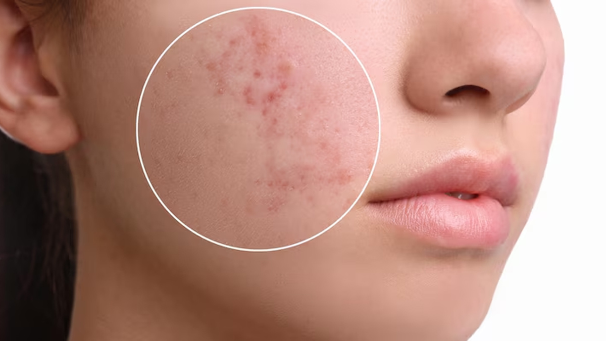 गर्मियों में क्यों होती एक्ने और पिंपल्स की समस्या- Why do we face problems of acne and pimples in summers? Why-is-pimple-and-acne-more-common-in-summer-inside