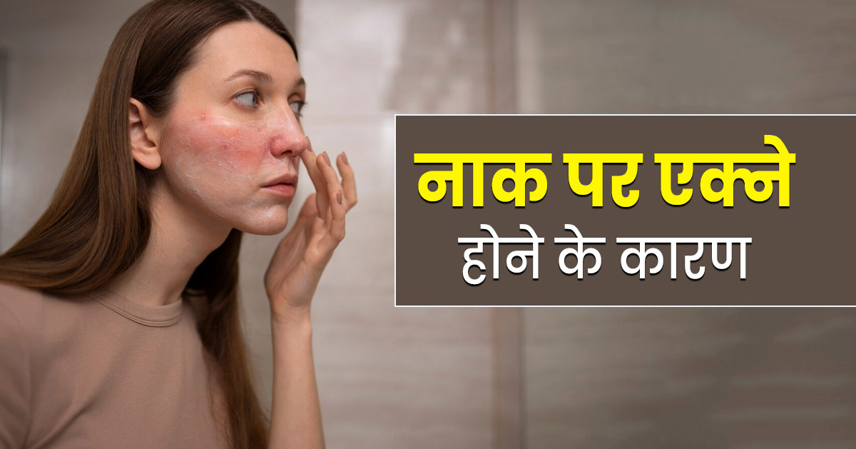 नाक पर एक्ने होने के पीछे हो सकते हैं ये कारण, जानें डॉक्टर से