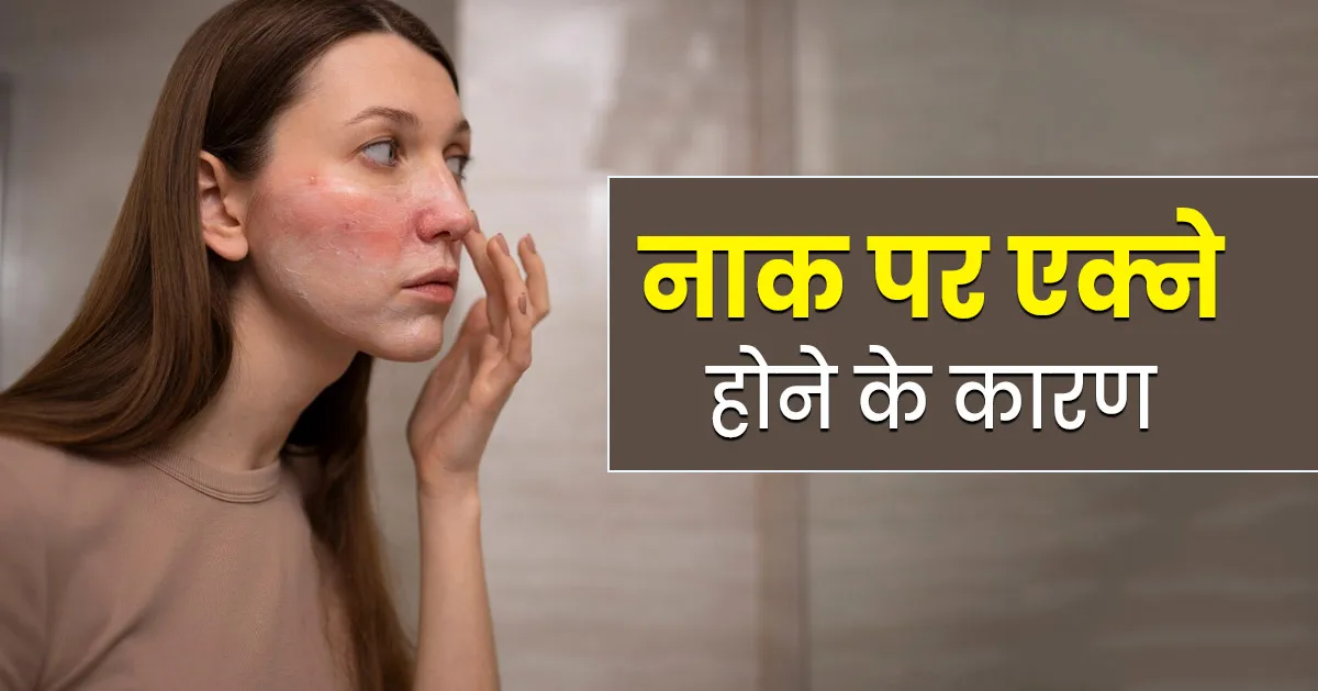 नाक पर एक्ने होने के पीछे हो सकते हैं ये कारण, जानें डॉक्टर से