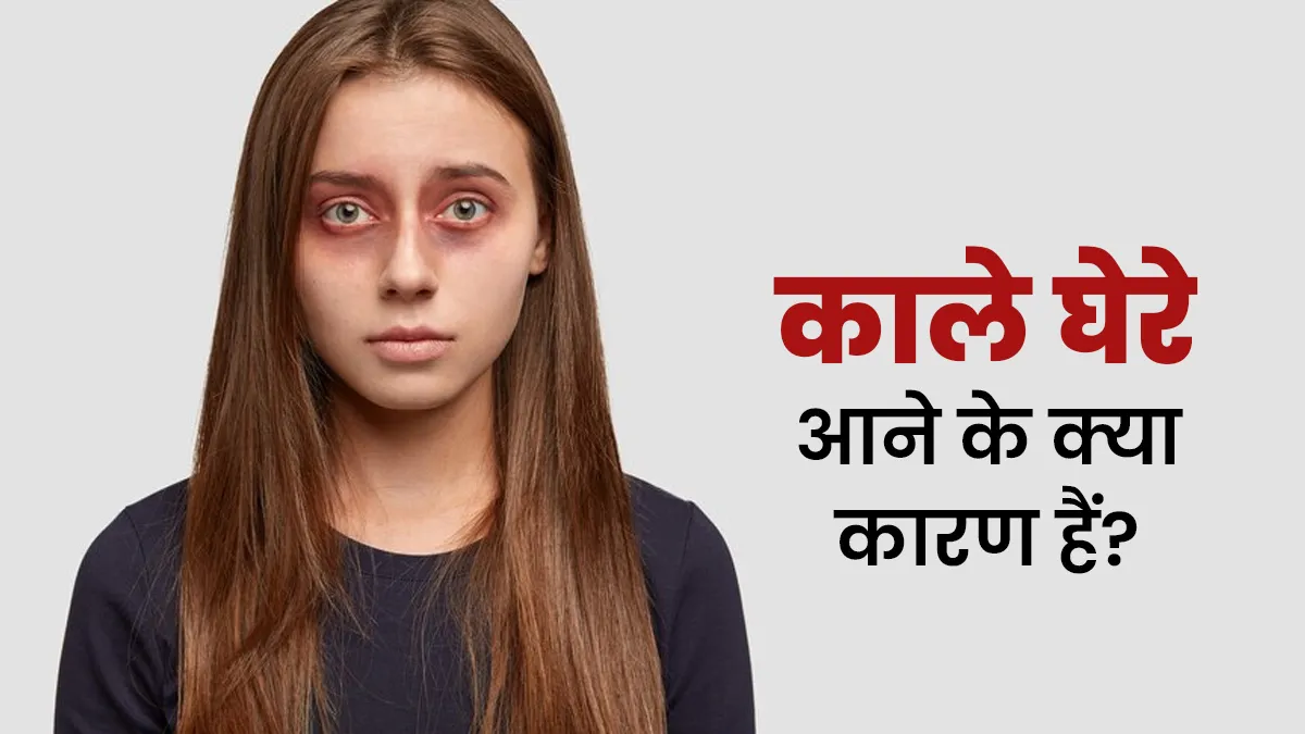 नींद की कमी ही नहीं, इन कारणों से भी हो सकते हैं काले घेरे