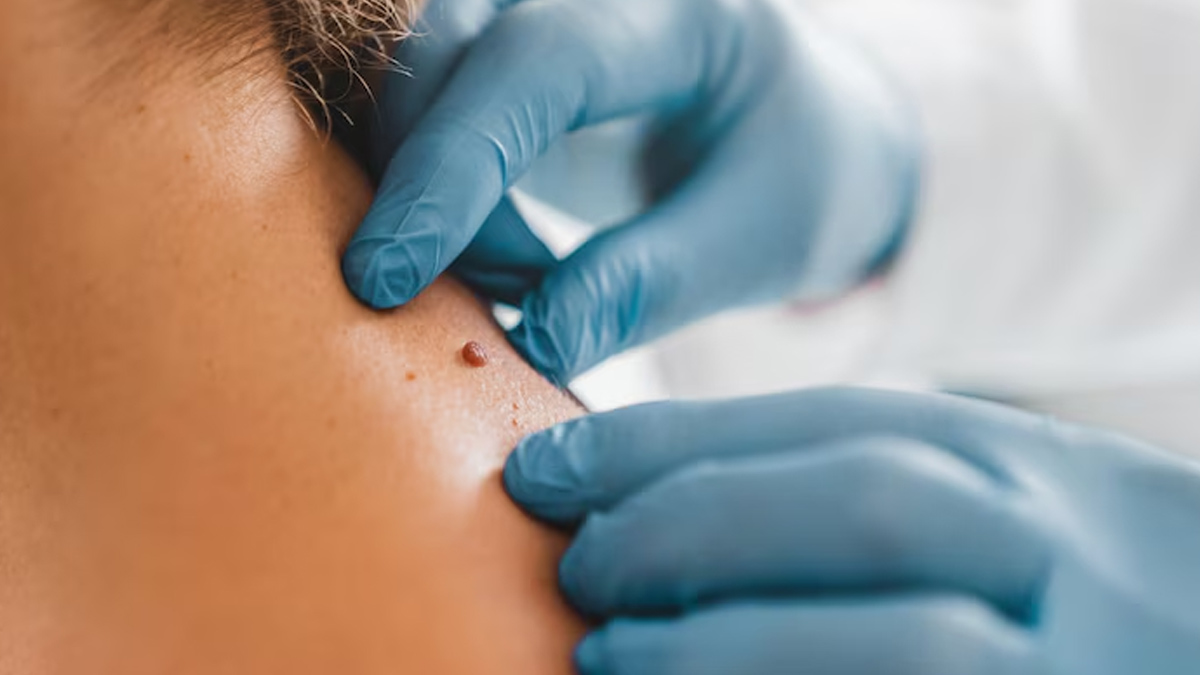 home remedies to remove warts 01 (4)