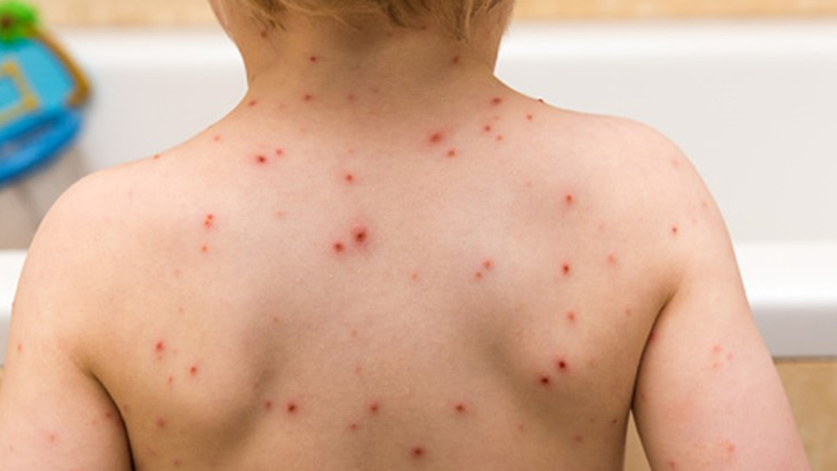 chickenpox
