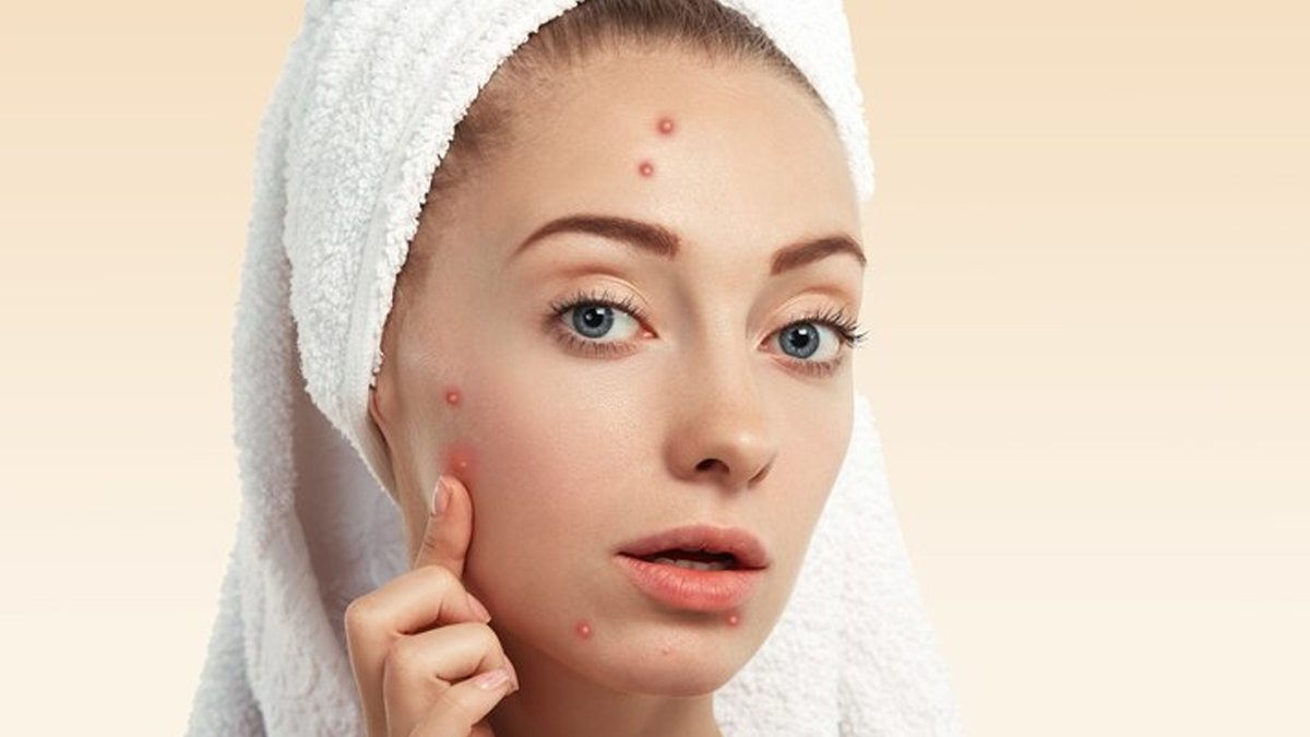 tips to prevent acne and pimples in hindi 1