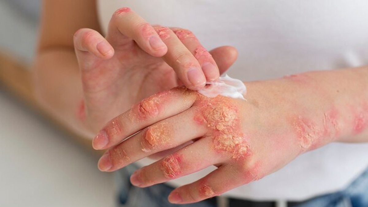 pregnancypsoriosis-inside