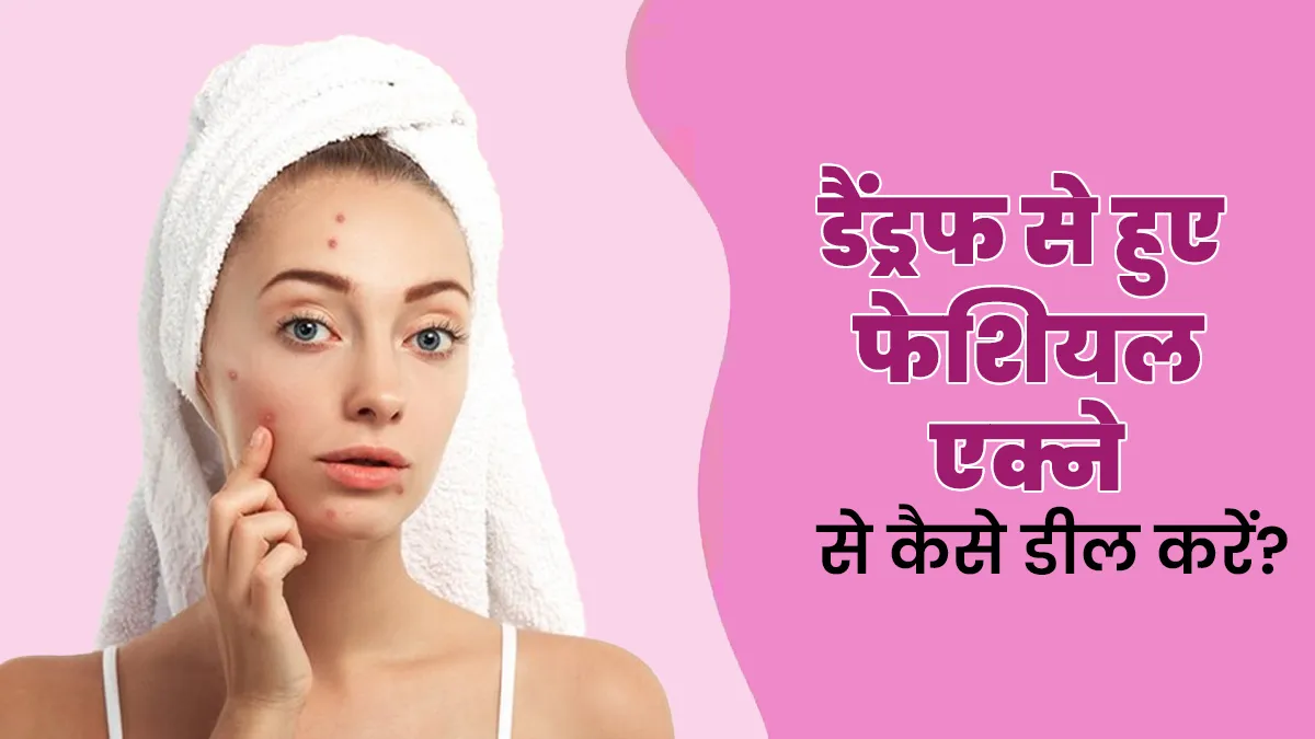 डैंड्रफ के कारण हो गए हैं फेशियल एक्ने? एक्सपर्ट से जानें इससे डील करने के टिप्स