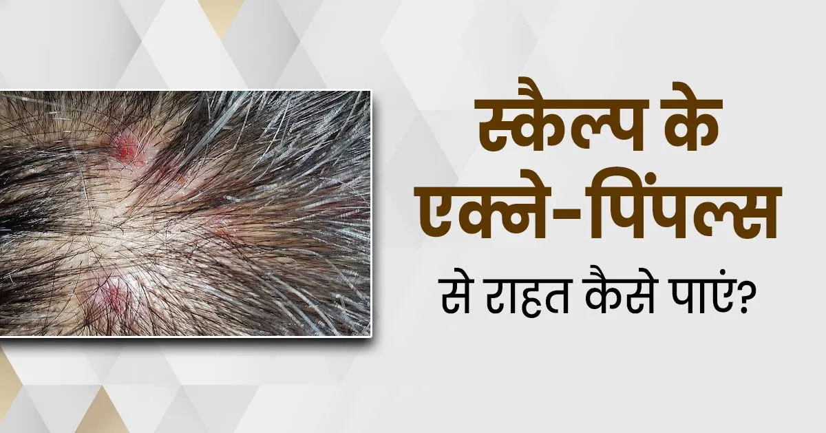 स्कैल्प के एक्ने-पिंपल्स से राहत पाने के लिए अपनाएं ये 6 टिप्स, जानें एक्सपर्ट से