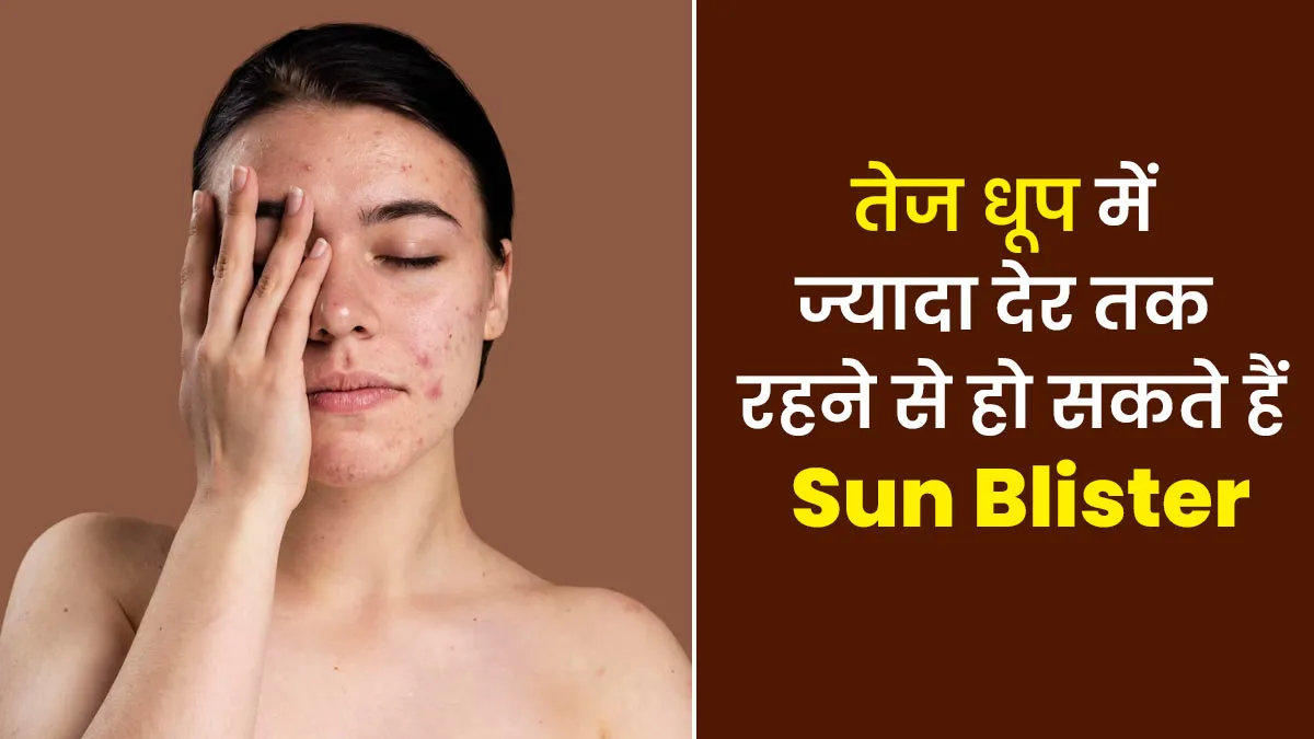 तेज धूप में ज्यादा देर तक रहने से हो सकते हैं छाले, जानें इसके लक्षण और बचाव
