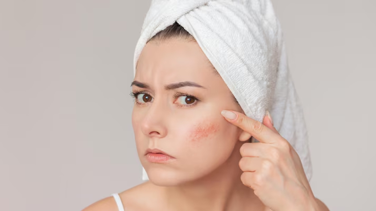 skin problems due to vitamin d deficiency 02 (2)