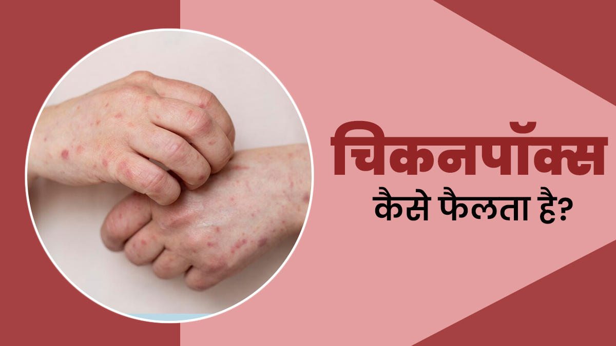 चिकन पॉक्स कैसे फैलता है और कितने समय तक संक्रामक रह सकता है? जानें डॉक्टर से