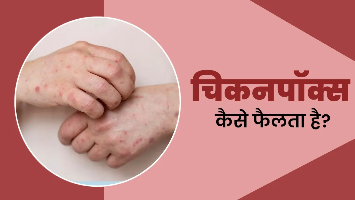 चिकन पॉक्स कैसे फैलता है और कितने समय तक संक्रामक रह सकता है? जानें डॉक्टर से