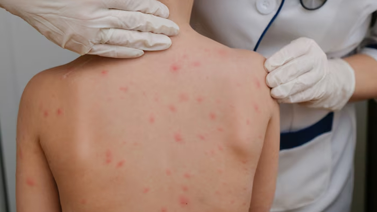CHICKENPOX (2)