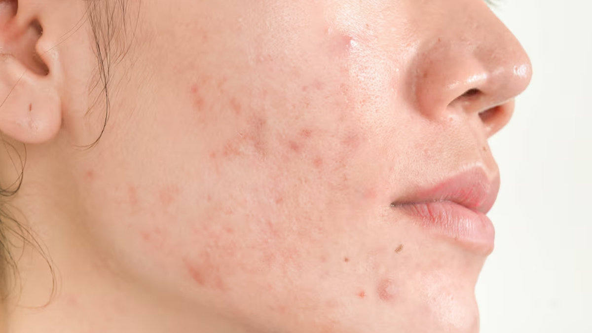 what not to do when having acne in hindi 01 (3)