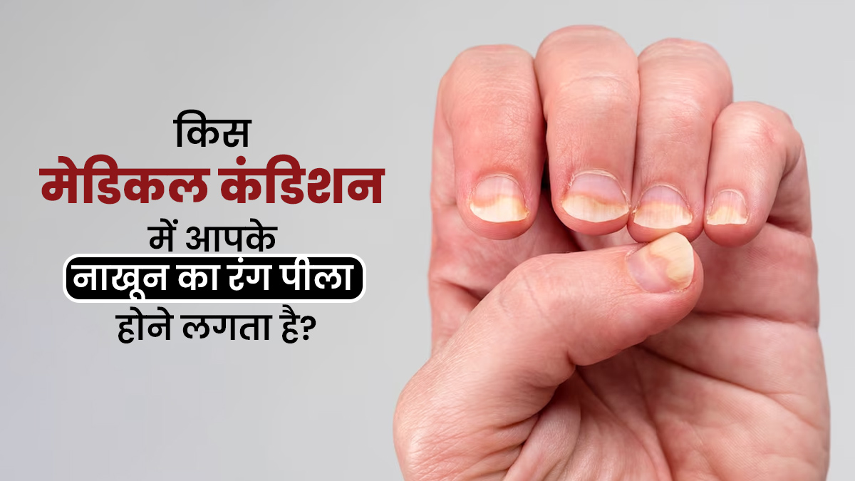 आपके नाखूनों का रंग भी हो रहा है पीला, तो जानें कौन सी मेडिकल कंडीशन हो सकती है इसकी वजह
